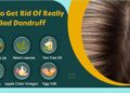 How To Get Rid Of Really Bad Dandruff