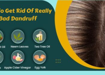 How To Get Rid Of Really Bad Dandruff | Treatments And Remedies 6 How To Get Rid Of Really Bad Dandruff
